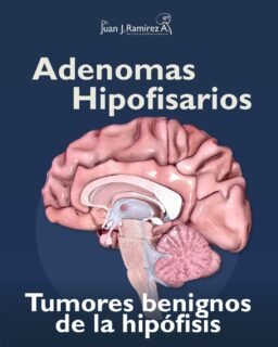 🧠 No todos los tumores cerebrales son malignos pero sí importantes.
Los adenomas hipofisarios son tumores benignos que pueden alterar hormonas, provocar dolor de cabeza o afectar la visión si no se detectan a tiempo. Un diagnóstico oportuno evita complicaciones mayores.