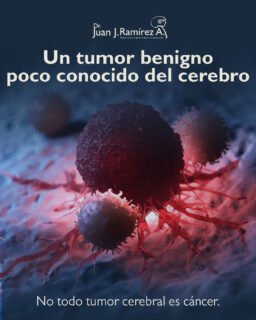 No todo tumor cerebral es cáncer. Existen lesiones benignas de crecimiento lento que, en muchos casos, no causan síntomas durante años. Conocerlas permite detectar a tiempo posibles cambios y actuar de forma adecuada. 🧠
-
📲Mándame mensaje y agendamos tu consulta para una valoración personalizada.