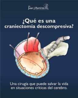La craneotomía descompresiva es un procedimiento que puede marcar la diferencia en situaciones críticas,
ya que permite aliviar la presión y proteger la función cerebral.
Se utiliza en casos graves, donde actuar a tiempo es fundamental.
Ante cualquier síntoma neurológico o situación de urgencia, una valoración oportuna puede cambiar el pronóstico. Agenda tu consulta y recibe atención especializada a tiempo.