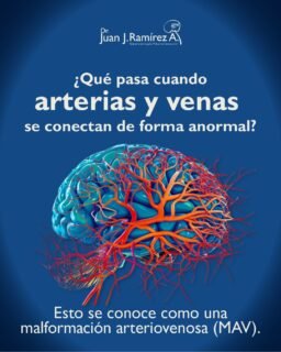 🧠 No todas las alteraciones vasculares son evidentes… pero sí importantes.
Cuando las arterias y venas se conectan de forma anormal, pueden generarse cambios en el flujo sanguíneo que aumentan el riesgo de complicaciones graves.
Detectarlo a tiempo permite tomar decisiones oportunas y prevenir riesgos mayores. 
-
📲 Agenda tu valoración: 33 31132125 📍 Guadalajara, Jalisco.