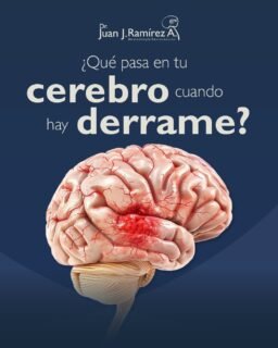 🧠 El cerebro necesita un flujo constante de sangre y oxígeno para mantener funciones básicas como el movimiento, el habla, la memoria y conciencia.Cuando ocurre un derrame cerebral, una parte del tejido cerebral deja de recibir oxígeno o sufre un sangrado, provocando daño neurológico en cuestión de minutos.
Dependiendo de la zona afectada, pueden presentarse alteraciones motoras, dificultad para hablar, pérdida de sensibilidad o secuelas neurológicas permanentes.
En neurología, el tiempo es fundamental para limitar el daño cerebral y mejorar el pronóstico del paciente.
📲 Agenda tu valoración.
📍 Guadalajara, Jalisco.