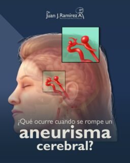 🧠 Cuando un aneurisma cerebral se rompe, ocurre una hemorragia que puede poner en riesgo la vida en minutos.
El síntoma más común es un dolor de cabeza súbito e intenso, acompañado en algunos casos de vómito, pérdida de conciencia, visión borrosa o dificultad para hablar.
En neurología, actuar rápido puede hacer una gran diferencia en el pronóstico del paciente.
📲 Agenda tu valoración: 33 3113 2125
📍 Guadalajara, Jalisco.