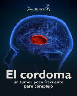 🧠 El cordoma es un tumor poco frecuente que se desarrolla en zonas complejas como la base del cráneo o la columna vertebral.
Debido a su ubicación, puede comprometer estructuras neurológicas importantes y provocar síntomas progresivos como dolor, alteraciones visuales, dificultad para caminar o problemas neurológicos.
Su diagnóstico y tratamiento requieren un abordaje altamente especializado para planear la mejor estrategia terapéutica según cada caso.
📲 Agenda tu valoración: 33 3113 2125
📍 Guadalajara, Jalisco.